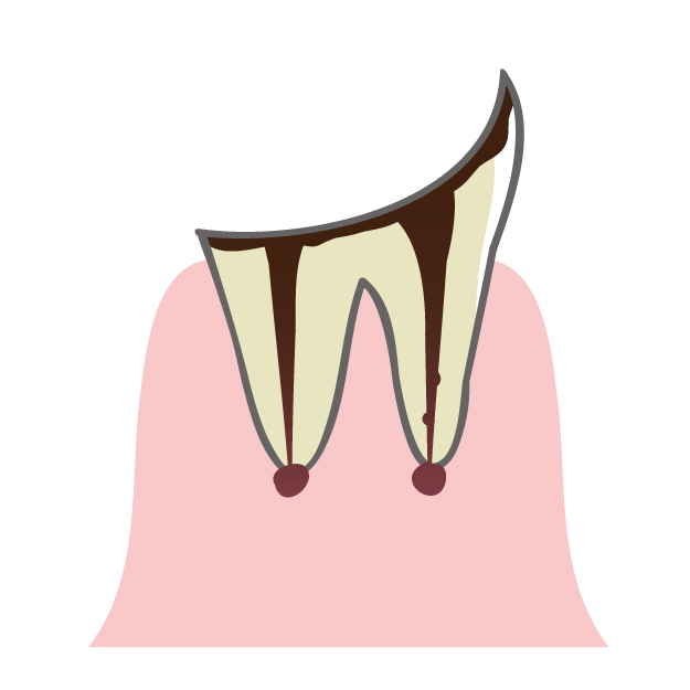 歯根の神経